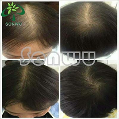 anti-hairloss